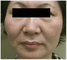 Vi Kim Chữa Da Lão Hoá Vi Kim Chữa Da Lão Hoá