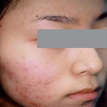 vi kim chữa da mụn  vi kim chữa da mụn