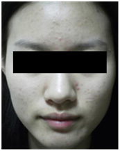 vi kim chữa da mụn  vi kim chữa da mụn