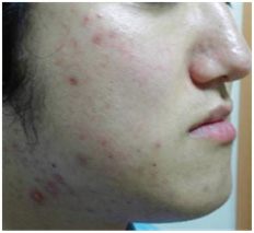 vi kim chữa da nhạy cảm  vi kim chữa da nhạy cảm