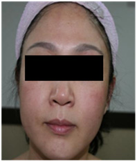 vi kim chữa da nhạy cảm  vi kim chữa da nhạy cảm