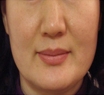 Da Nhạy Cảm  Da Nhạy Cảm