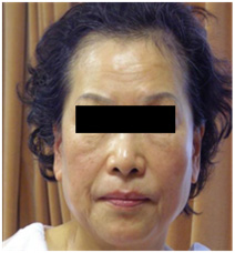 Vi kim chữa da lão hoá  Vi kim chữa da lão hoá