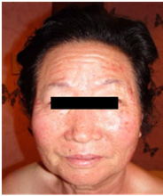 Vi kim chữa da mụn Vi kim chữa da mụn