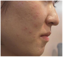 vi kim chữa da mụn vi kim chữa da mụn