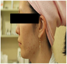 vi kim chữa da mụn vi kim chữa da mụn