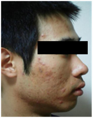 vi kim chữa da mụn vi kim chữa da mụn