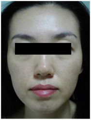 vi kim chữa da mụn  vi kim chữa da mụn