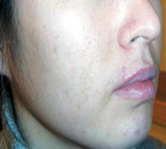 vi kim chữa da mụn  vi kim chữa da mụn