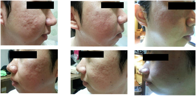 Hiệu quả Vi Kim Hiệu quả Vi Kim